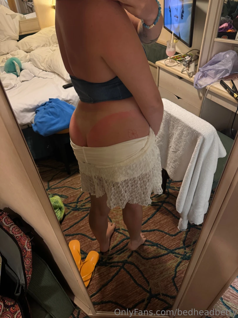 My sunburn is so real 