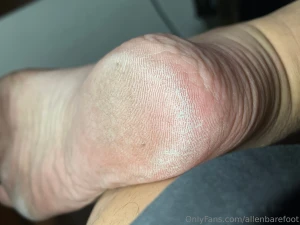 My soles today dry weather makes my soles looks more callous