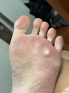 My soles today dry weather makes my soles looks more callous part 9
