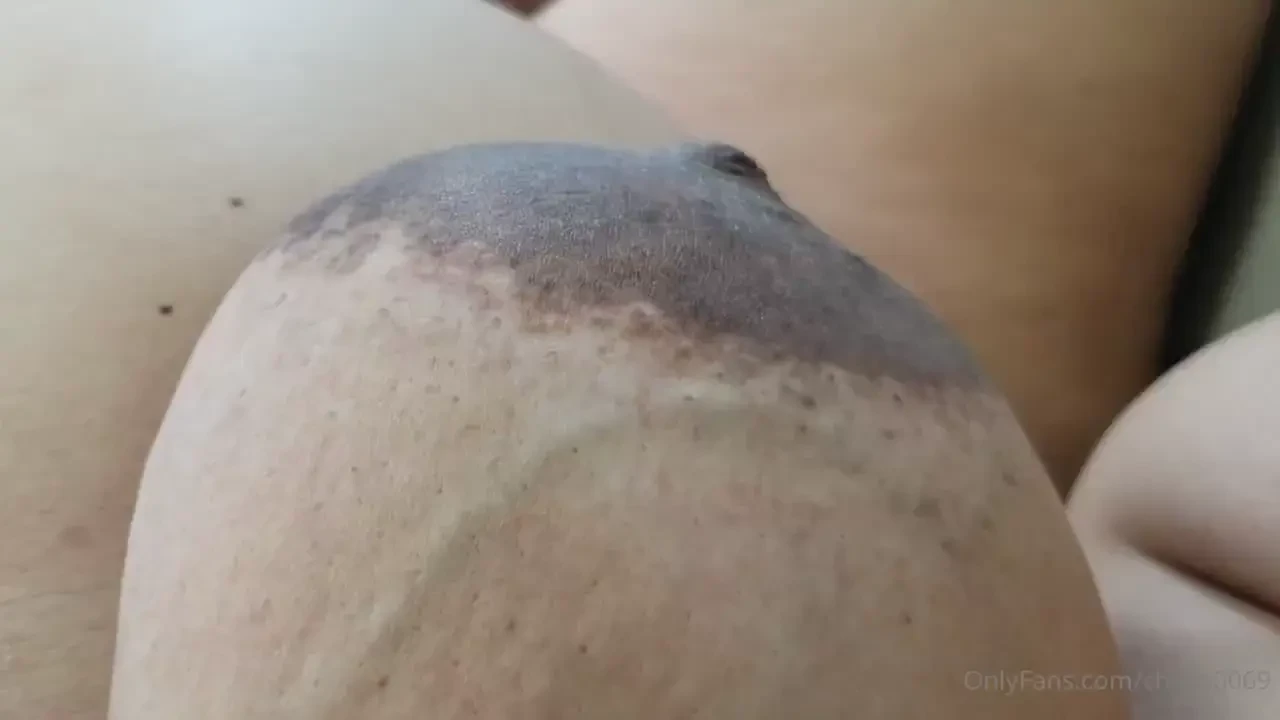 My viens are popping on my boobies more and more they re getting ready 