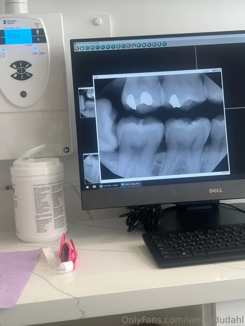 Hey dahls so i have a bit of an emergency i need my wisdom tooth 