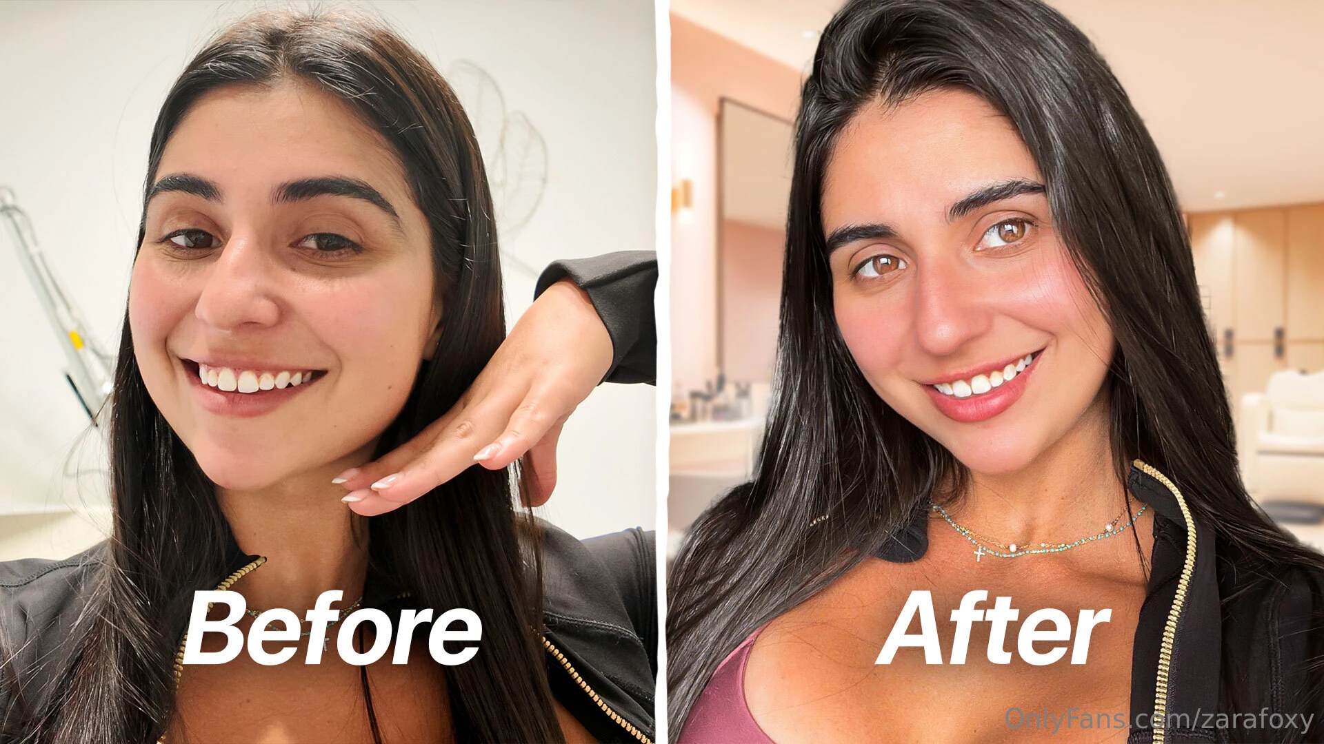 First time doing baby botox in today s video i m taking the plunge 