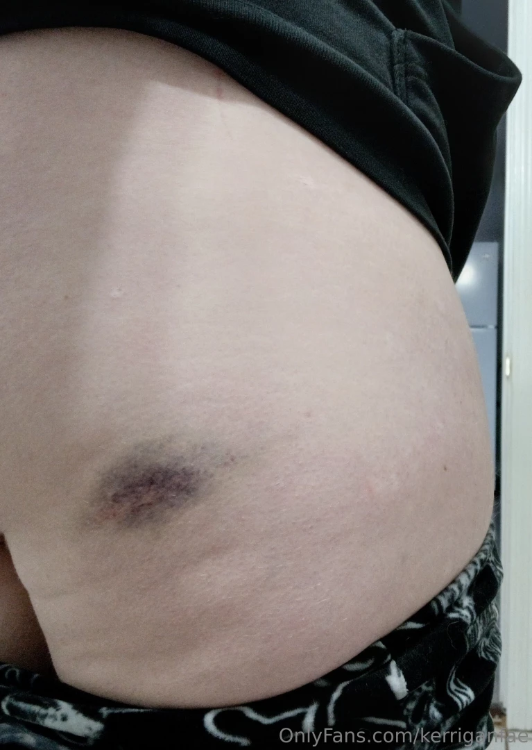Day two bruise 