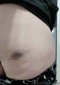 Day two bruise