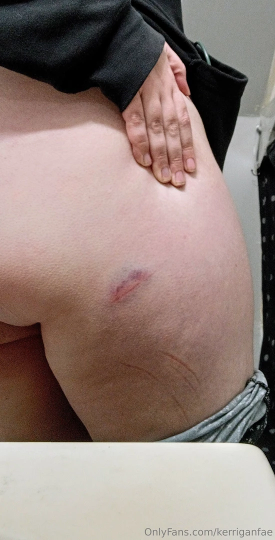 Always have to earn at least one battle scar while moving it hurts so 