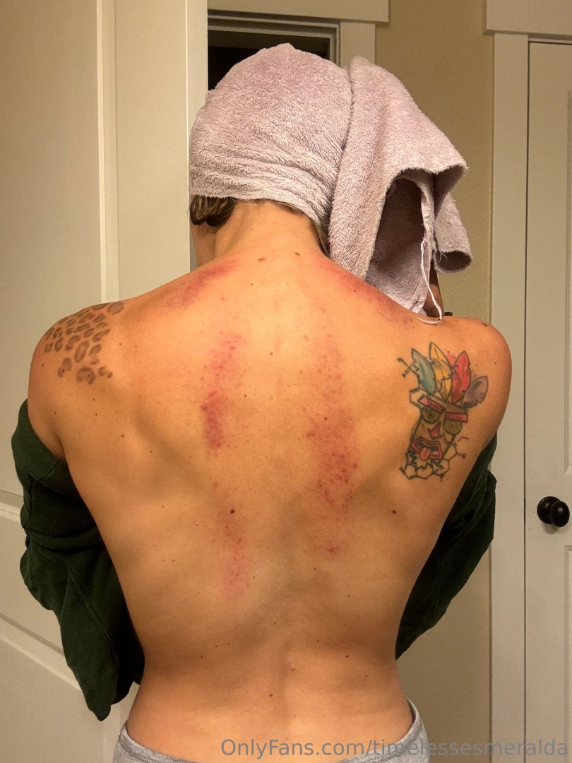 Do we have any back lovers i got a treatment done 