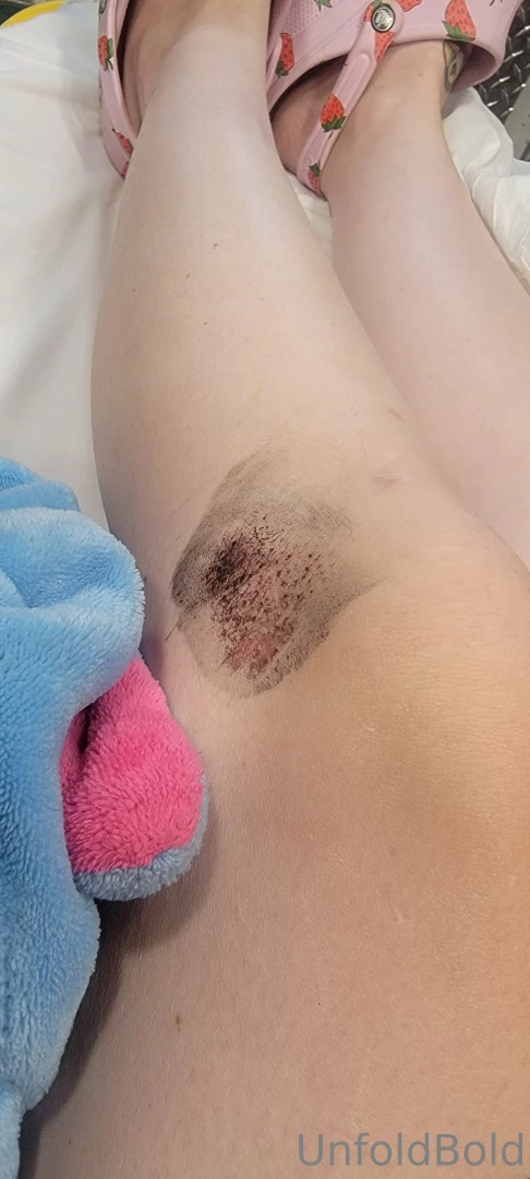 So guys i got hit by a car today in my wheelchair heading to physical part 2 