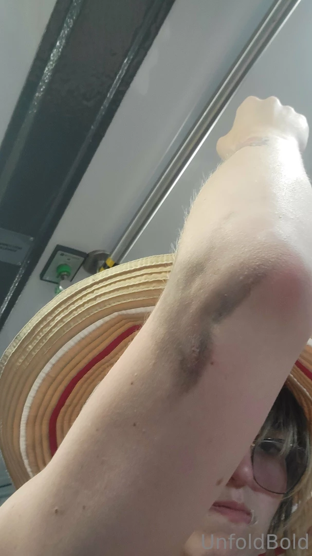 So guys i got hit by a car today in my wheelchair heading to physical part 1 