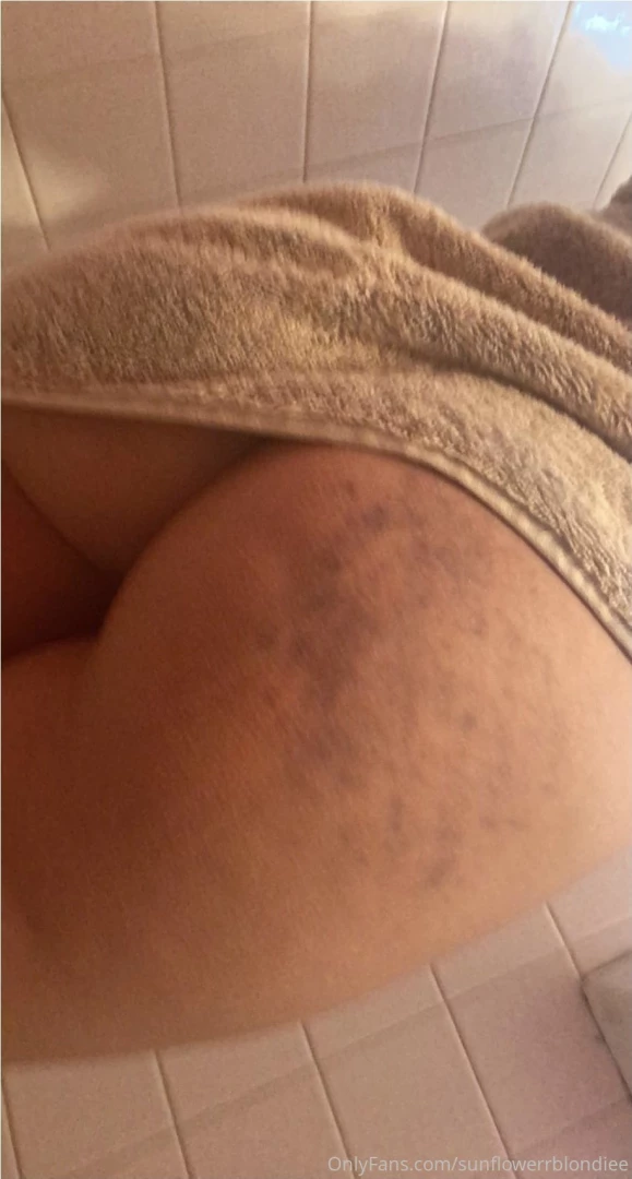 I wonder where these bruises came from 