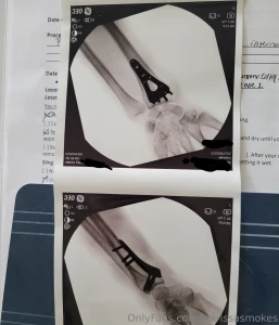 Pretty serious personal update i broke my wrist pretty fucking bad on