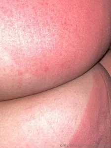 We have since entered the itchy sunburn stage part 4