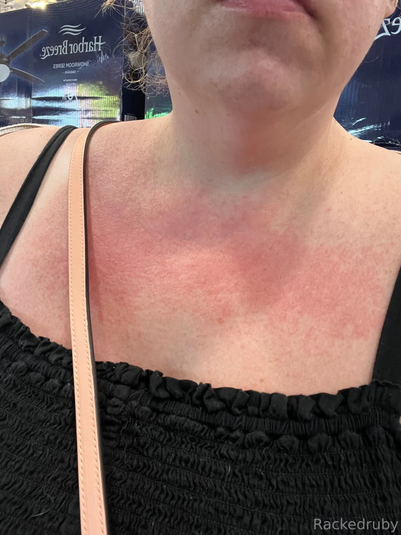 Okkkk sooooo thag body oil gave me a super nice rash send tips on part 1 