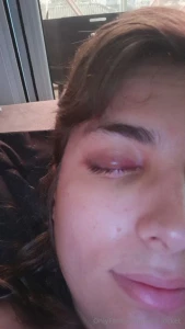 Bruised vulnerable and ready to obey my purple eye and broken hand won