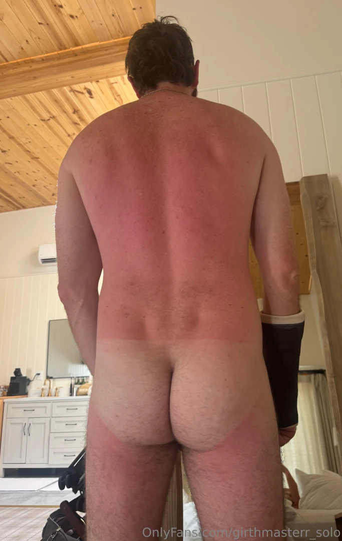 Look at how sunburnt i got 