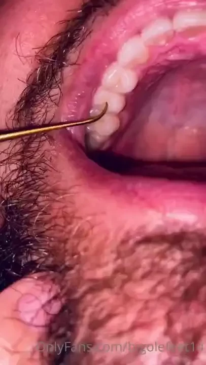 New cavity going back to the dentist for a filling in 2 weeks hit the 