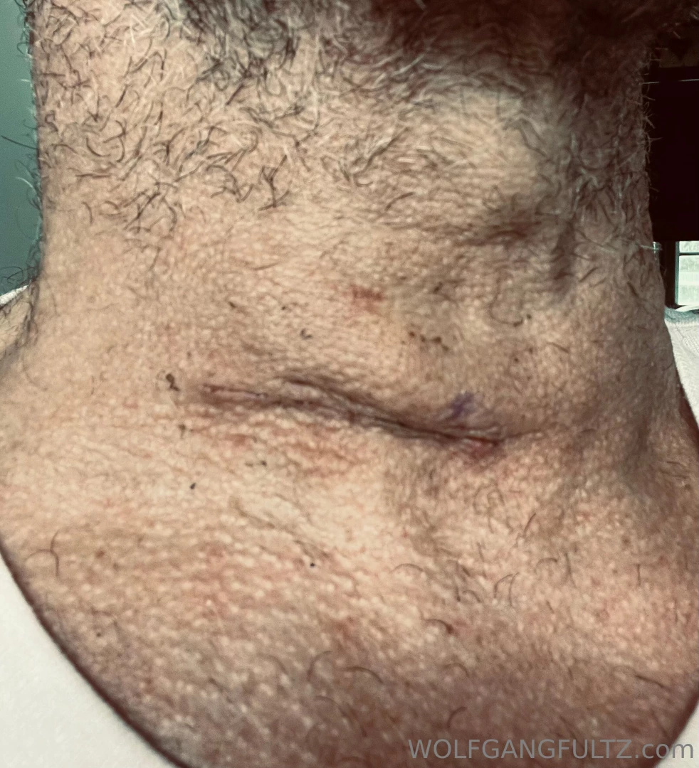 Hey fuckers a couple recent pics for ya i survivied my spine surgery part 1 