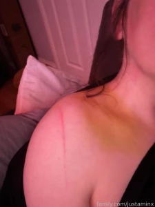 Dislocated my right collar bone the other day can someone koss ot part 1