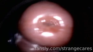 An endoscope view of the pinpoint vibrator going into my cervix is a