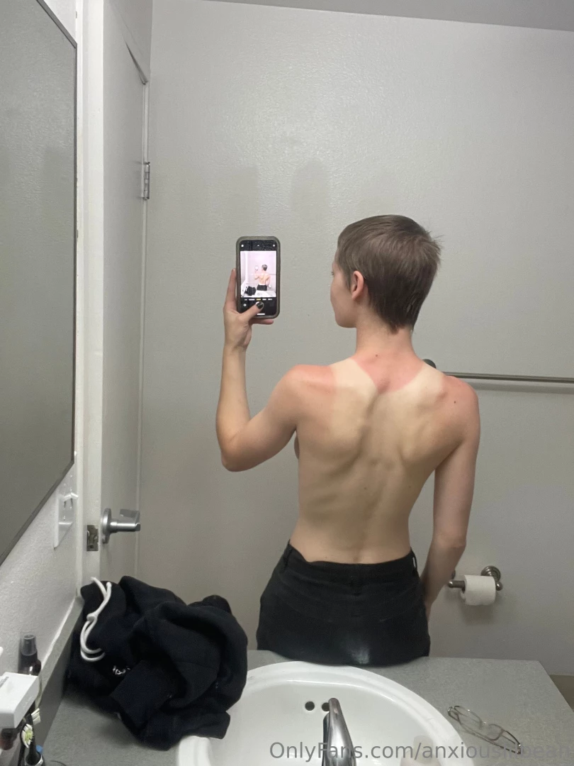 I got burrnnt the other day and here s the aftermath 