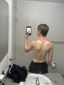 I got burrnnt the other day and here s the aftermath