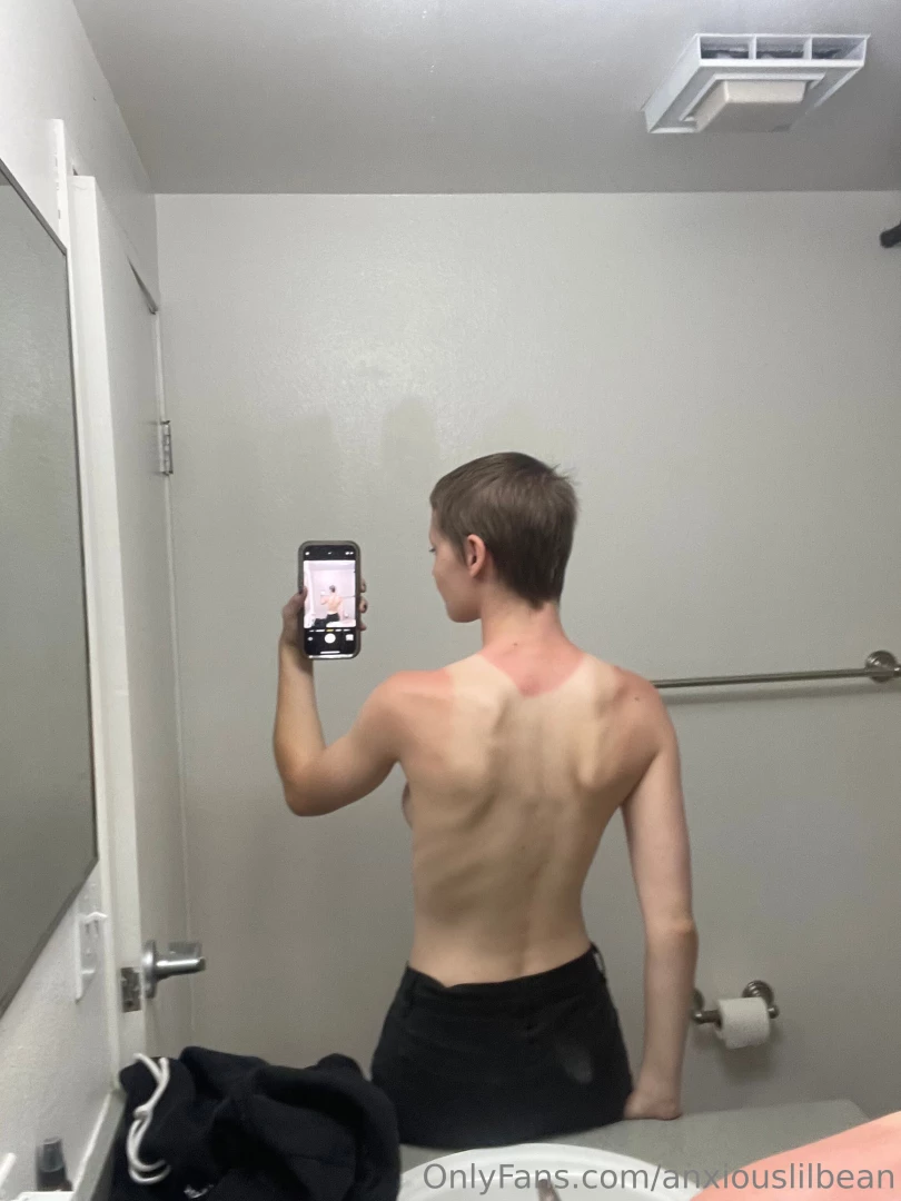 I got burrnnt the other day and here s the aftermath part 1 