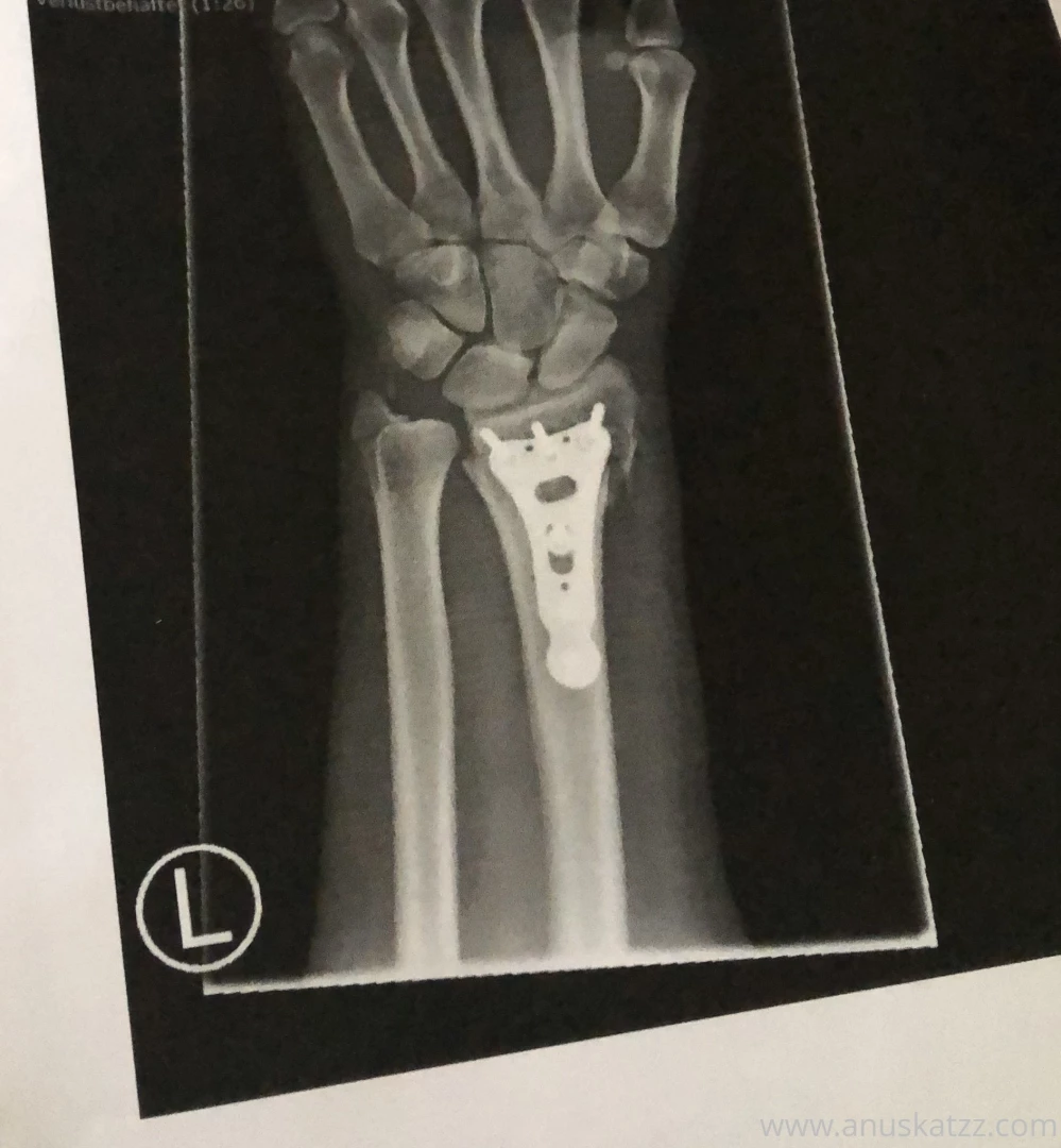 I got a titan plate stuck to my bones who help me heal the broken arm part 1 