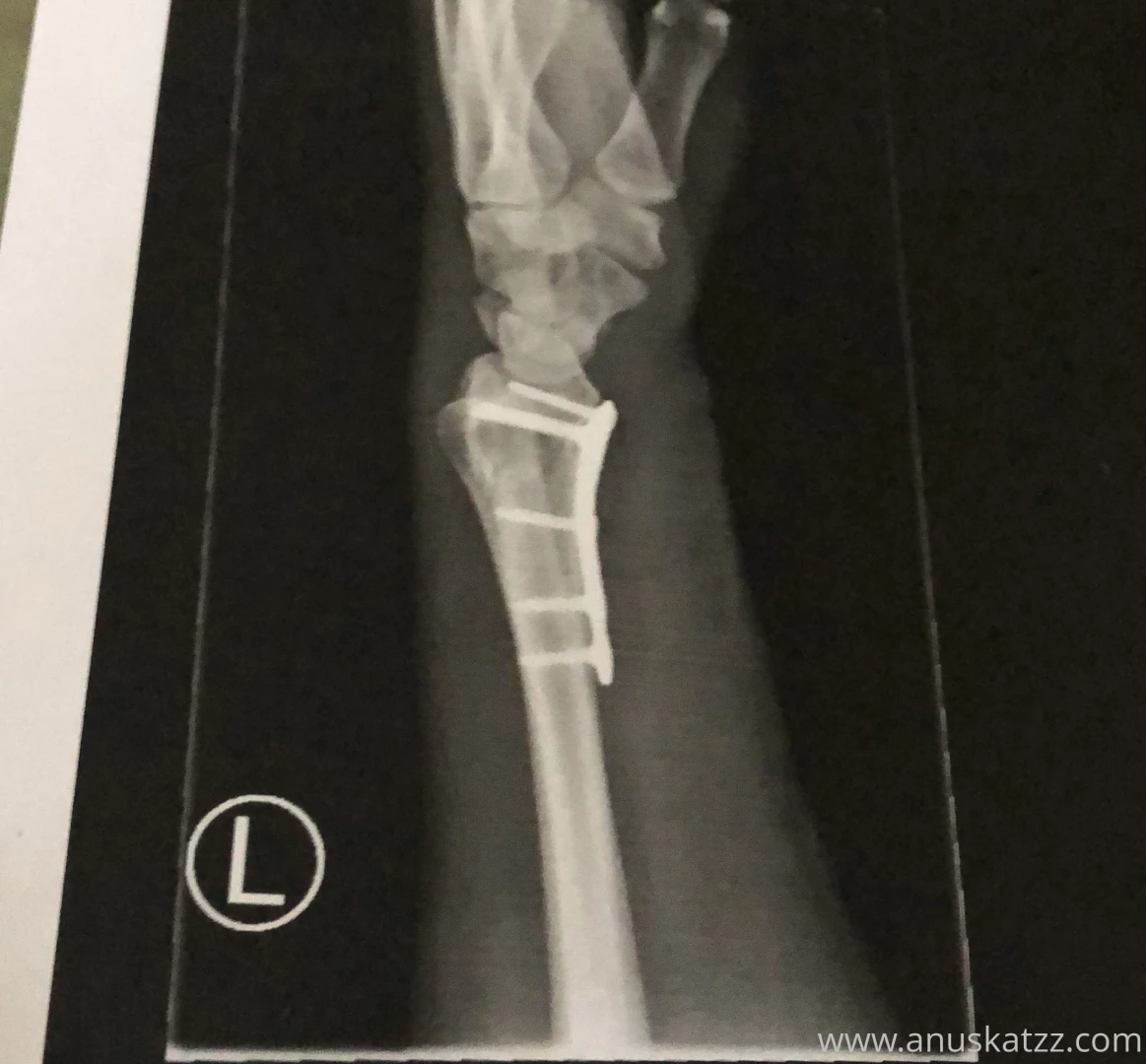 I got a titan plate stuck to my bones who help me heal the broken arm 