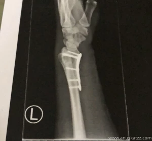 I got a titan plate stuck to my bones who help me heal the broken arm