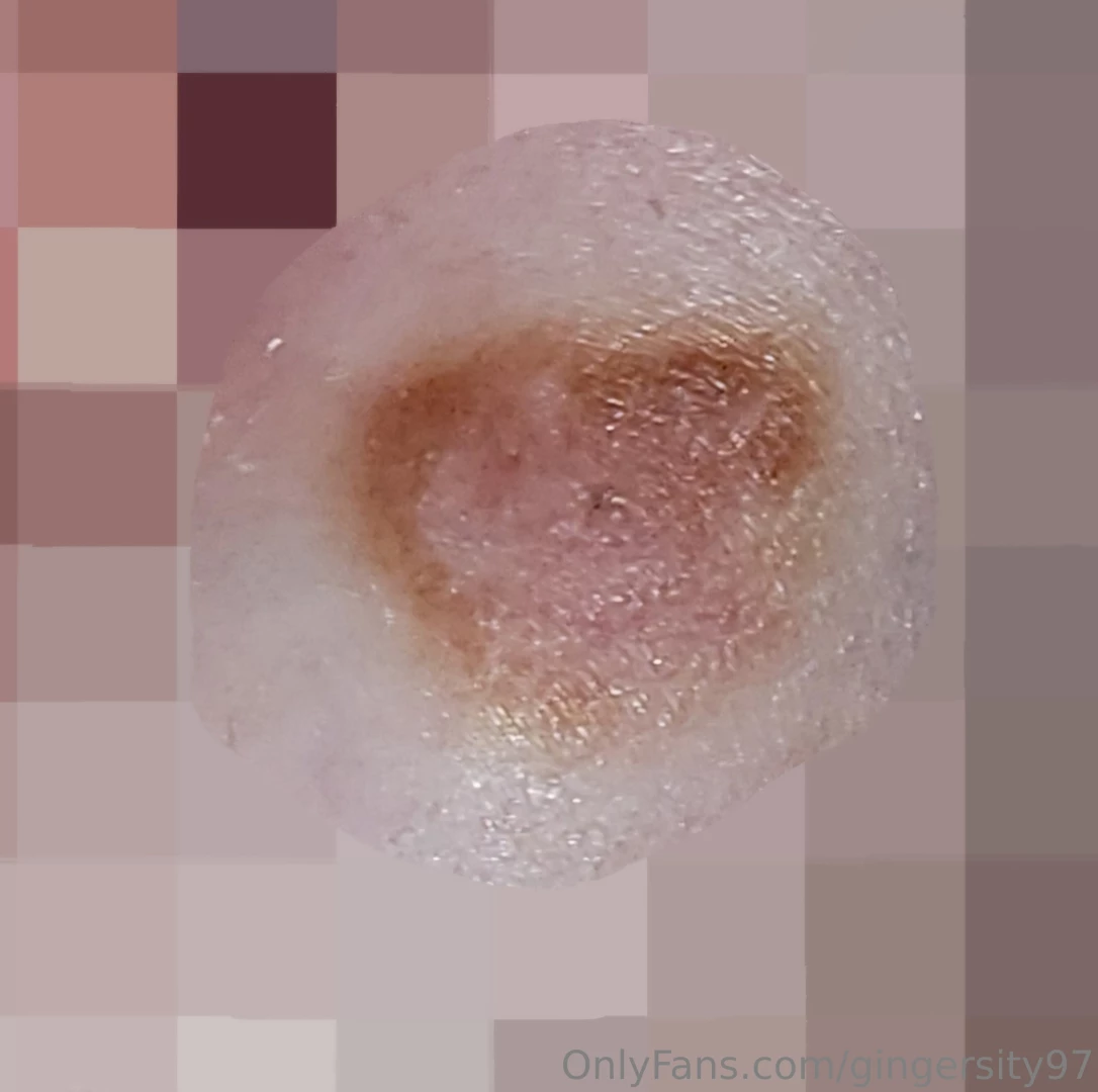 Had my creepy mole biopsied today fingers crossed for clean results part 1 