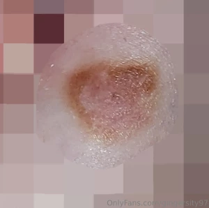 Had my creepy mole biopsied today fingers crossed for clean results part 1