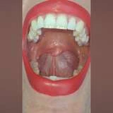 tiny_uvula