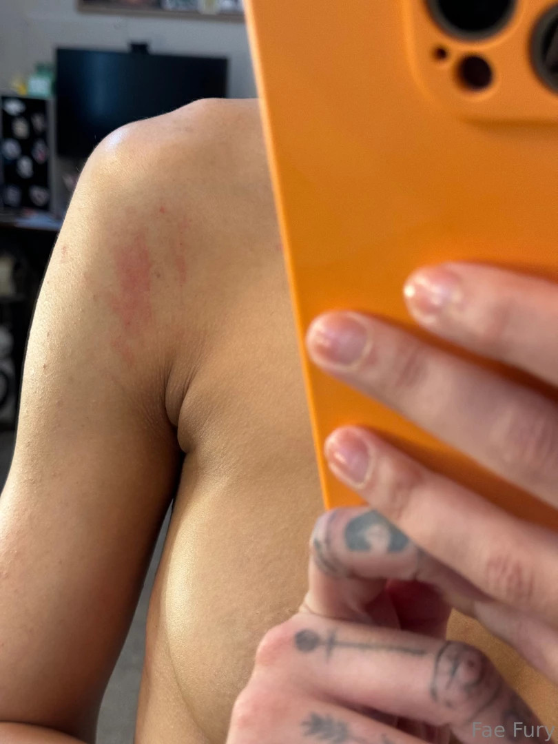 Literally everywhere and itches like hell this sucks so much part 1 