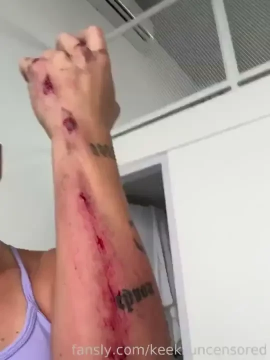 Hahahahahahaaha injury nude from the scooter crash i was in 