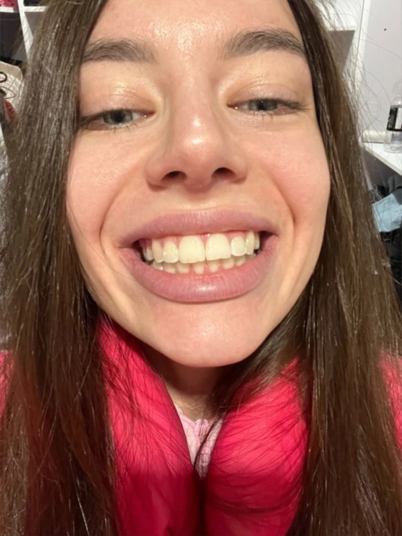 My braces were removed how do you like it part 4 