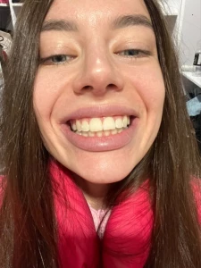 My braces were removed how do you like it part 4