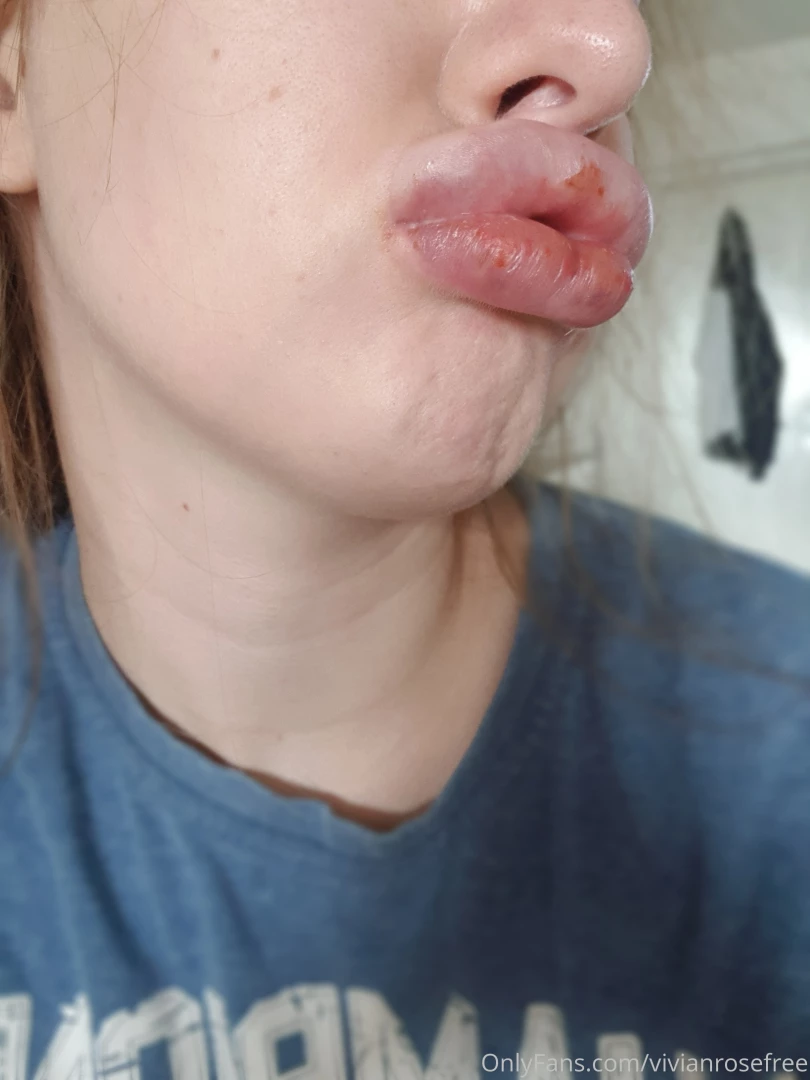 vivianrosefree - My lips straight after getting my latest fillers when they were at 