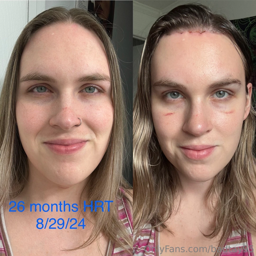 Here s an update on my appearance before vs after surgery what do we 