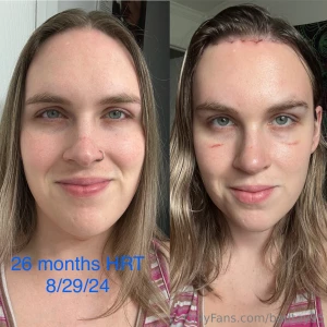 Here s an update on my appearance before vs after surgery what do we