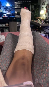 Post surgery and doing ok pain is a 100 10 but naps n 4 20 helps