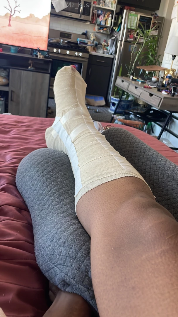 Sad to say i m gonna be mia for a bit got a compound ankle fracture 