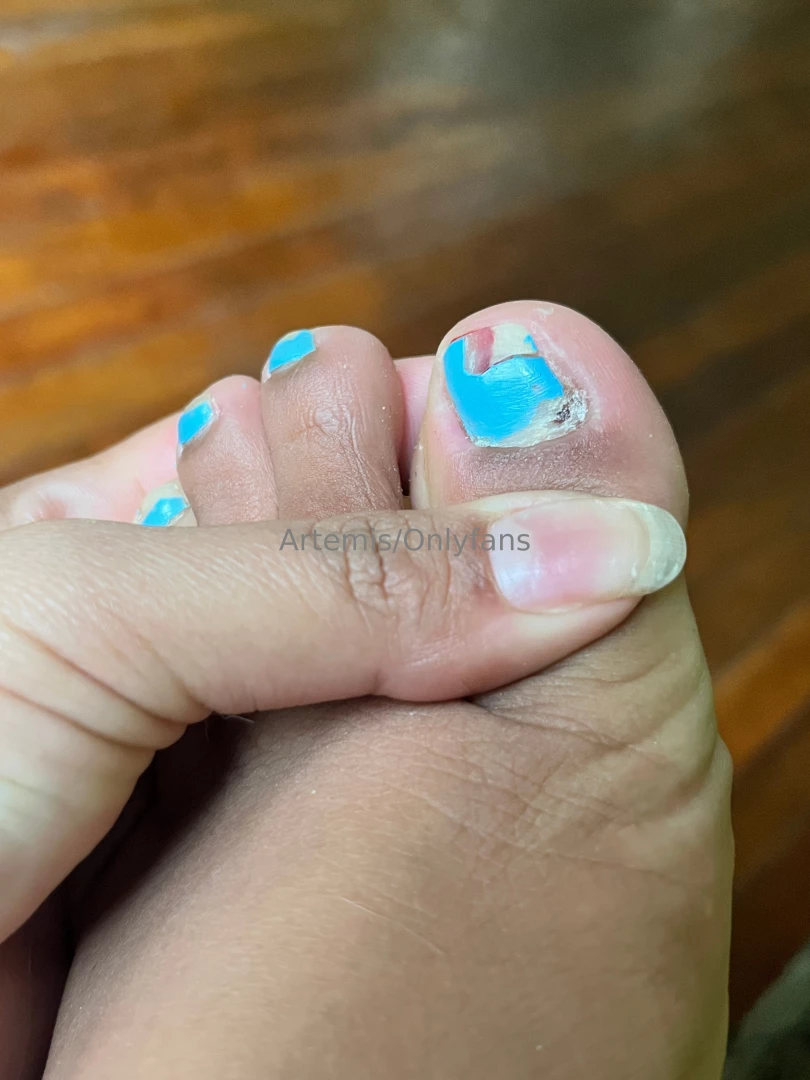 Bye to my nail god it hurts a lot the good thing is that i have 