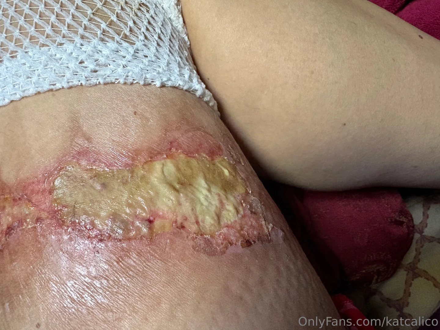 I have the same problem as my grandma apparently i have a latex 