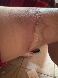 I have the same problem as my grandma apparently i have a latex part 6