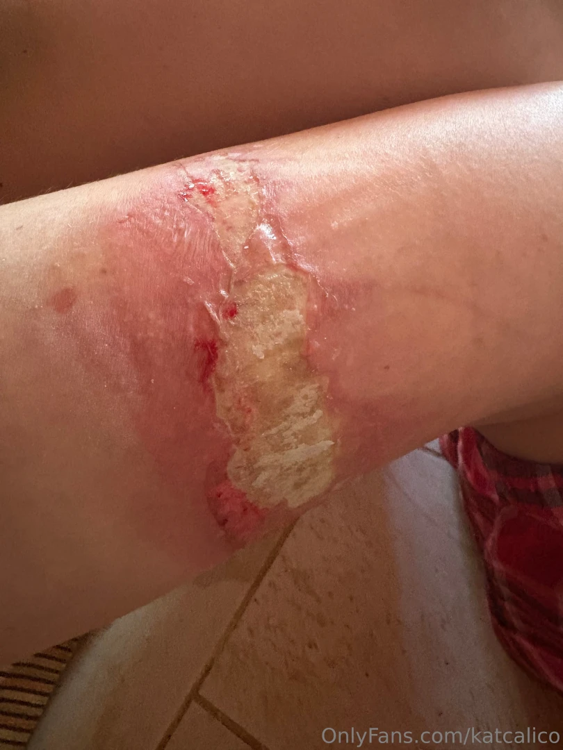 I have the same problem as my grandma apparently i have a latex part 3 