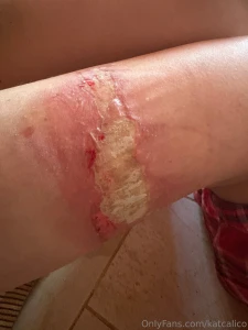 I have the same problem as my grandma apparently i have a latex part 3