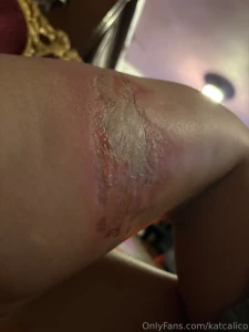 I have the same problem as my grandma apparently i have a latex part 5