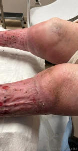 I have the same problem as my grandma apparently i have a latex part 1