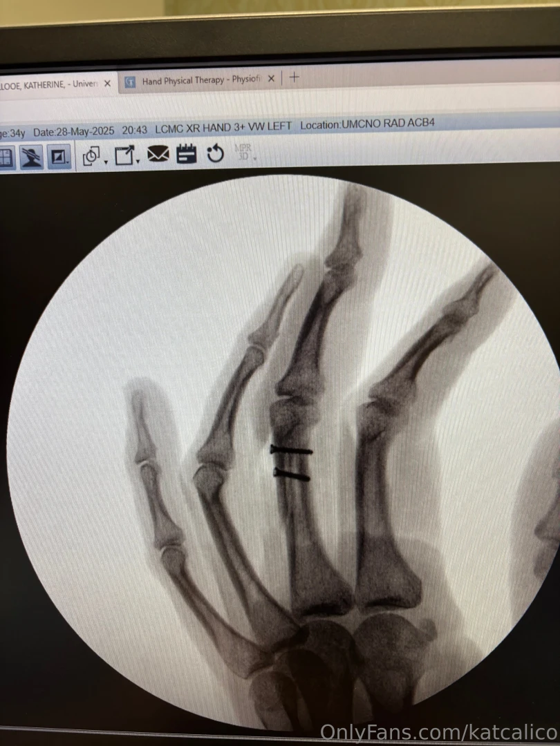 2 weeks after surgery 