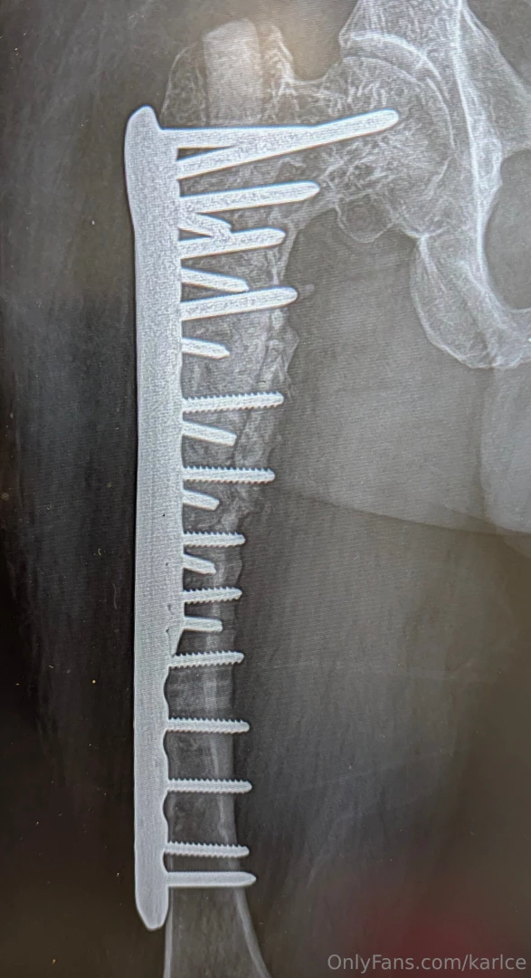 Latest set of hardware for those interested 