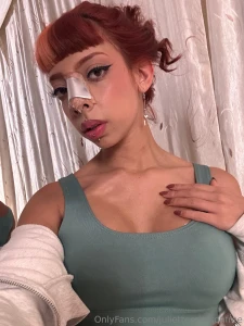 Post op update i m healing really nicely and i hope i can get back to